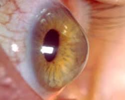 علاج القرنية المخروطية